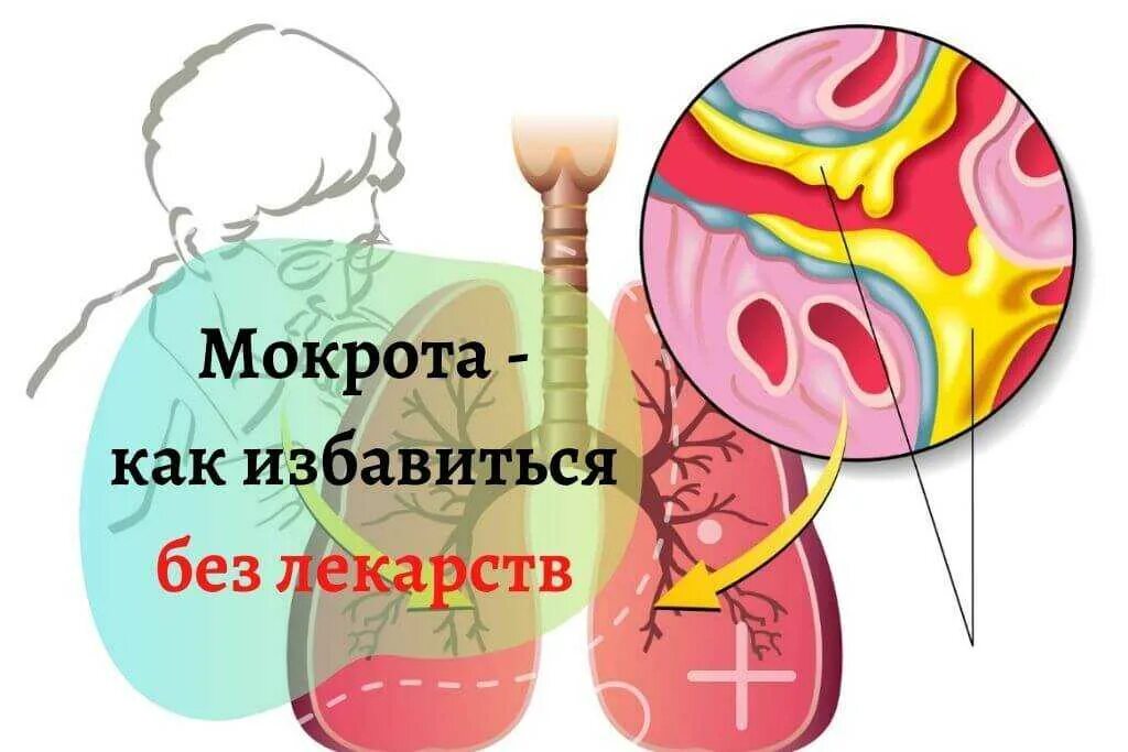 Почему мокрота в горле. Каизбавится.,от.мокроты.. средство от мокроты в носоглотке. от мокроты в горле лекарство.