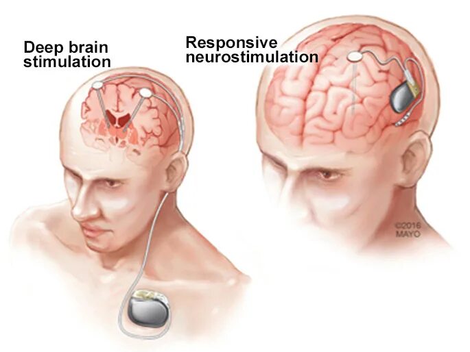 Deep brain. Brain stimulation. Deep Brain stimulation. Brain stimulation Deep у детей с ДЦП.