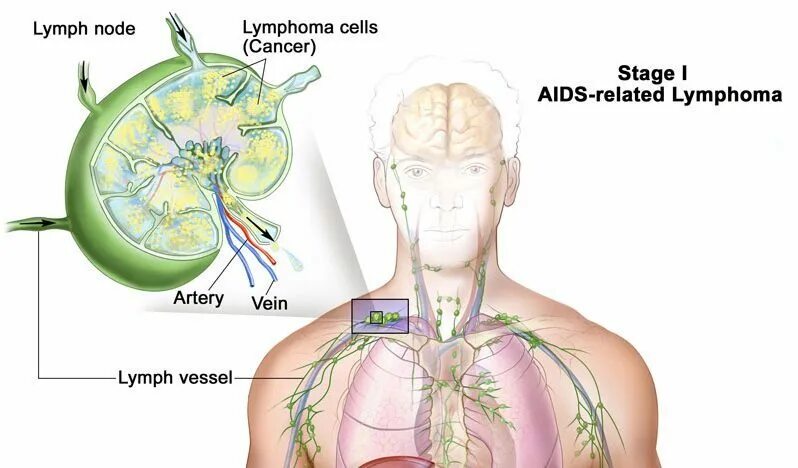 Лимфома лимфатические узлы. Лимфома Ходжкина лимфоузлы поражение. GРАК лимфатической системы. Опухоли лимфоидной системы.