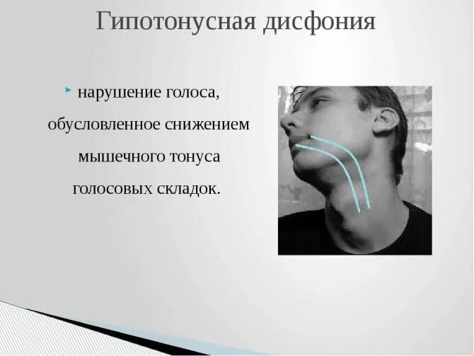 Дисфония. Гипотонусные нарушения. Расстройства голоса. Гипертонусная дисфония. Потеря голоса причины