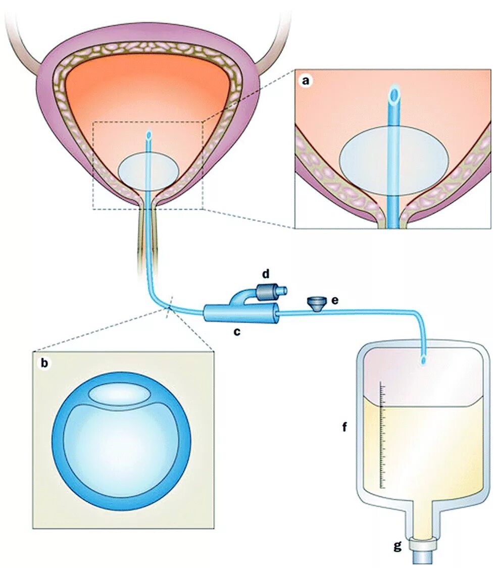 Цистостома мочевого пузыря катетер. Цистостома катетер Фолея. Катетер Фолея в мочевом пузыре у женщин. Схема катетера для мочевого пузыря.