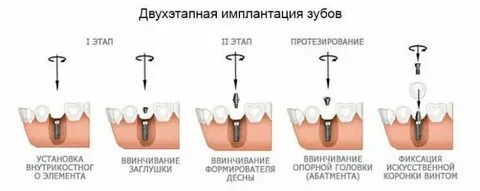Через сколько вставляет