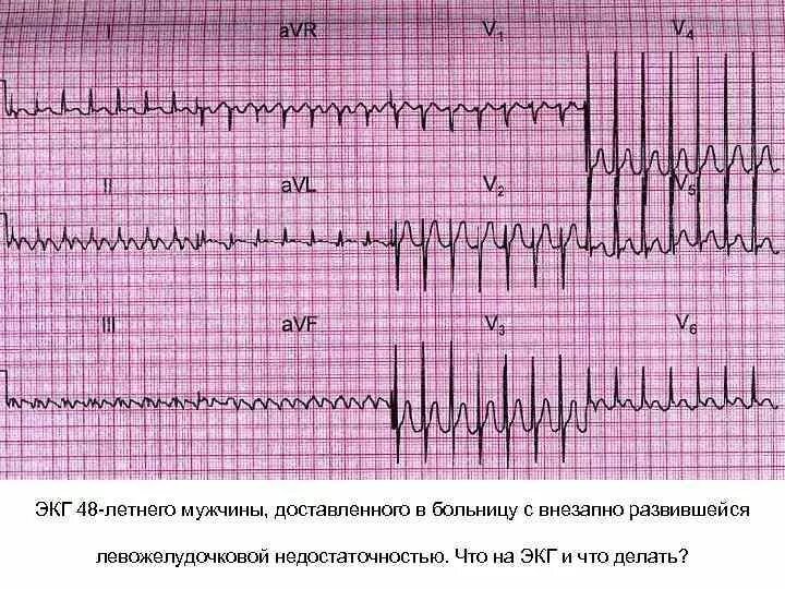 Тахисистолия это. Левожелудочковая сердечная недостаточность ЭКГ. Острая левожелудочковая недостаточность на ЭКГ. ЭКГ при острой сердечной недостаточности. ЭКГ признаки острой левожелудочковой недостаточности.
