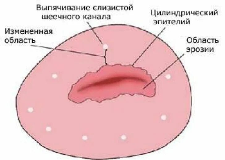 Изменения эпителия матки. Эктопия цилиндрического эпителия. Эктропион цилиндрического эпителия это. Эрозированный эктропион.