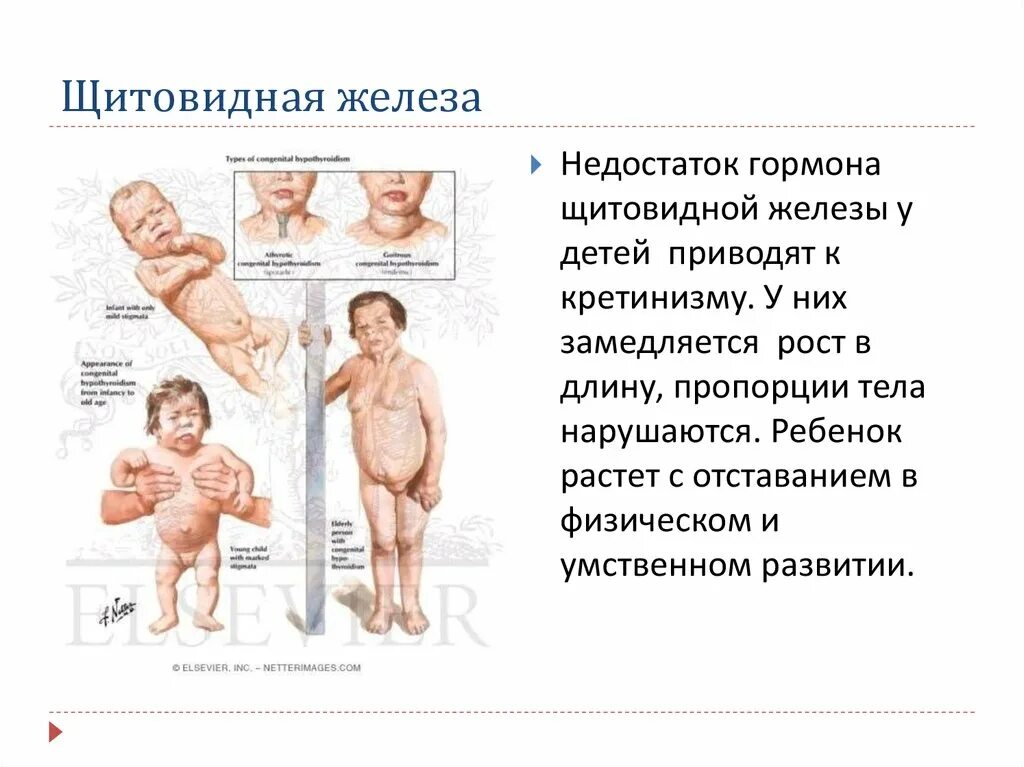 Рост желез. Недостаток гормонов щитовидной железы. недостаток гормонов щитовидной железы в детском. недостаток гармоно в щитовидной железы. недостаток недостаток гормонов щитовидной железы у.