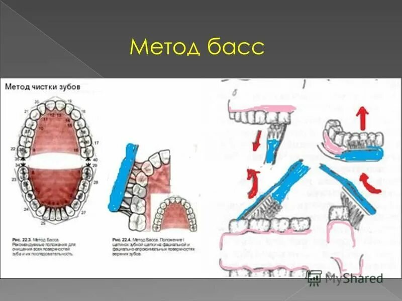 Метод басса чистка зубов. Алгоритм чистки зубов методом басса. Метод Леонарда чистки зубов.