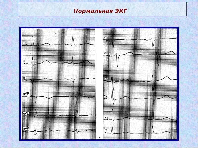 ЭКГ норма в 12 отведениях. Норма ЭКГ во всех отведениях. Нормальные отведения на ЭКГ. ЭКГ здорового человека в 12 отведениях. Экг со скольки