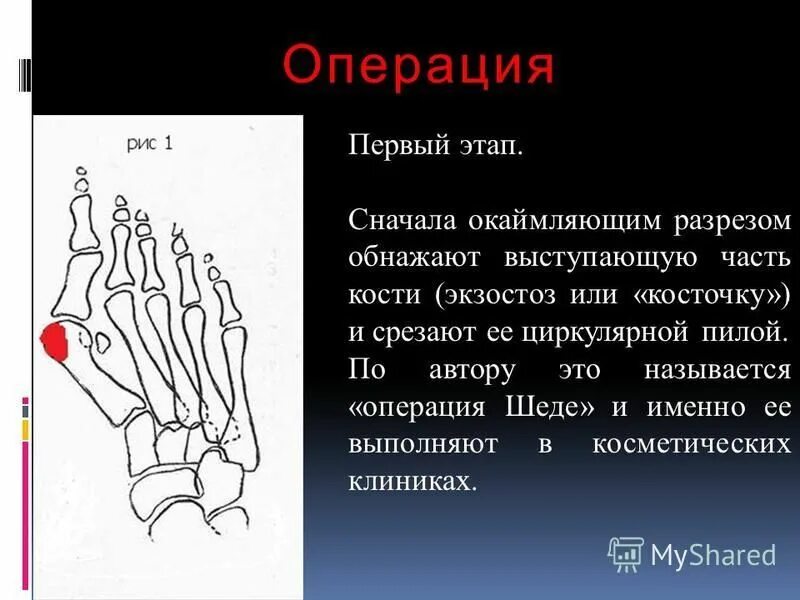 Степени вальгусной деформации 1 пальца стопы. Степени вальгусной деформации 1 пальца стопы