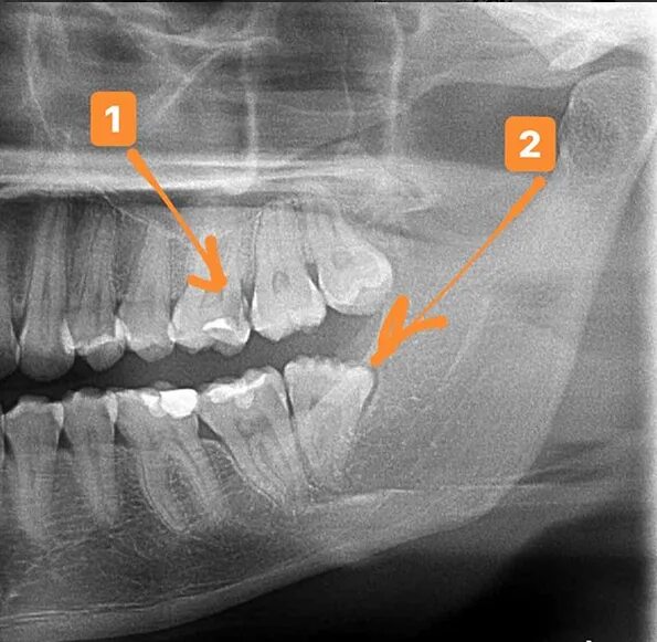 Снимок зубов видное. ОПТГ кариес снимок зубов. ОПТГ снимок зуб мудрости.
