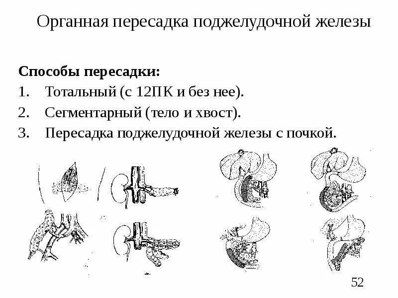 Трансплантация эндокринных желез. Трансплантация клеток поджелудочной железы. Трансплантация поджелудочной железы показания. Трансплантация бета клеток поджелудочной железы. Пересадка поджелудочной в россии