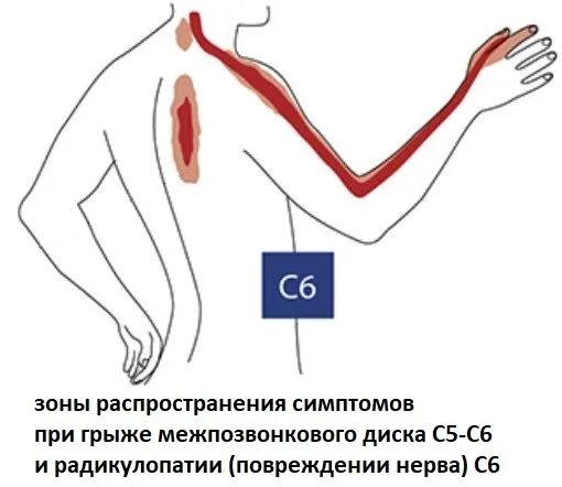 Радикулопатия с6