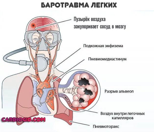 Газовая эмболия кессонная болезнь. Баротравма легких. Баротравма легких причины. Что такое баротравма при взрыве