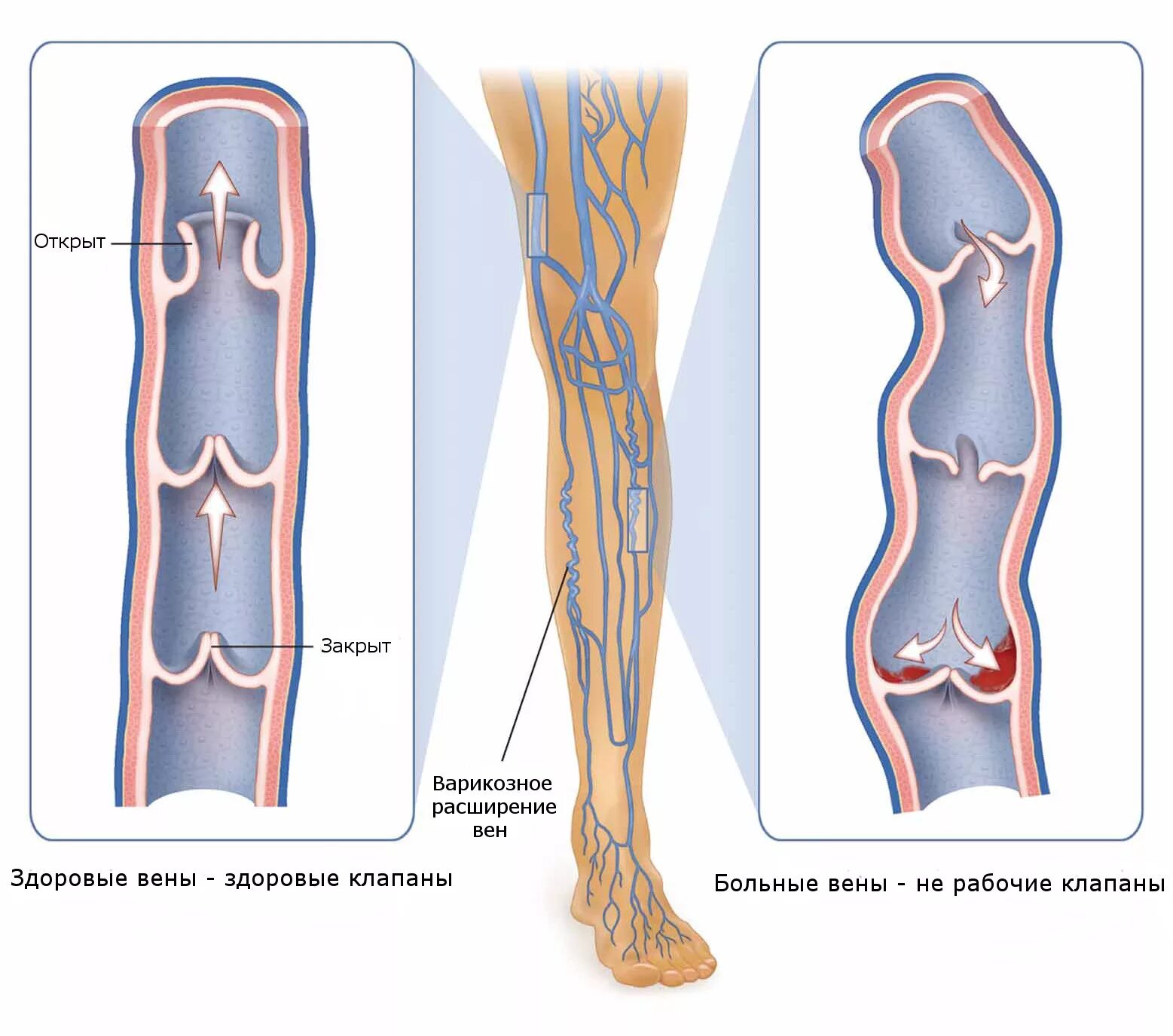 Варикозное расширение вен (ВРВ) нижних конечностей. Венозные клапаны в сосудах нижних конечностей человека. Варикозное расширение вен клапаны нижних. Строение вен нижних конечностей варикоз. Тромбоз бпв