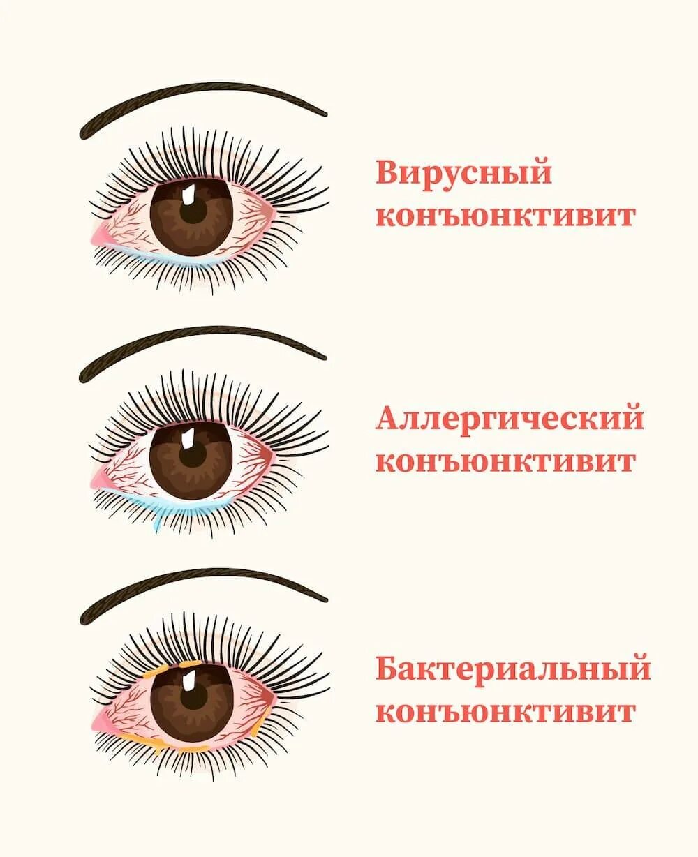 Конъюнктивит причины и лечение у взрослых. Бактериальный конъюнктивит комаровский. вирусный и бактериальный конъюнктивит. вирусный конъюнктивит симптомы. симптомы конъюнктивита у взрослых.