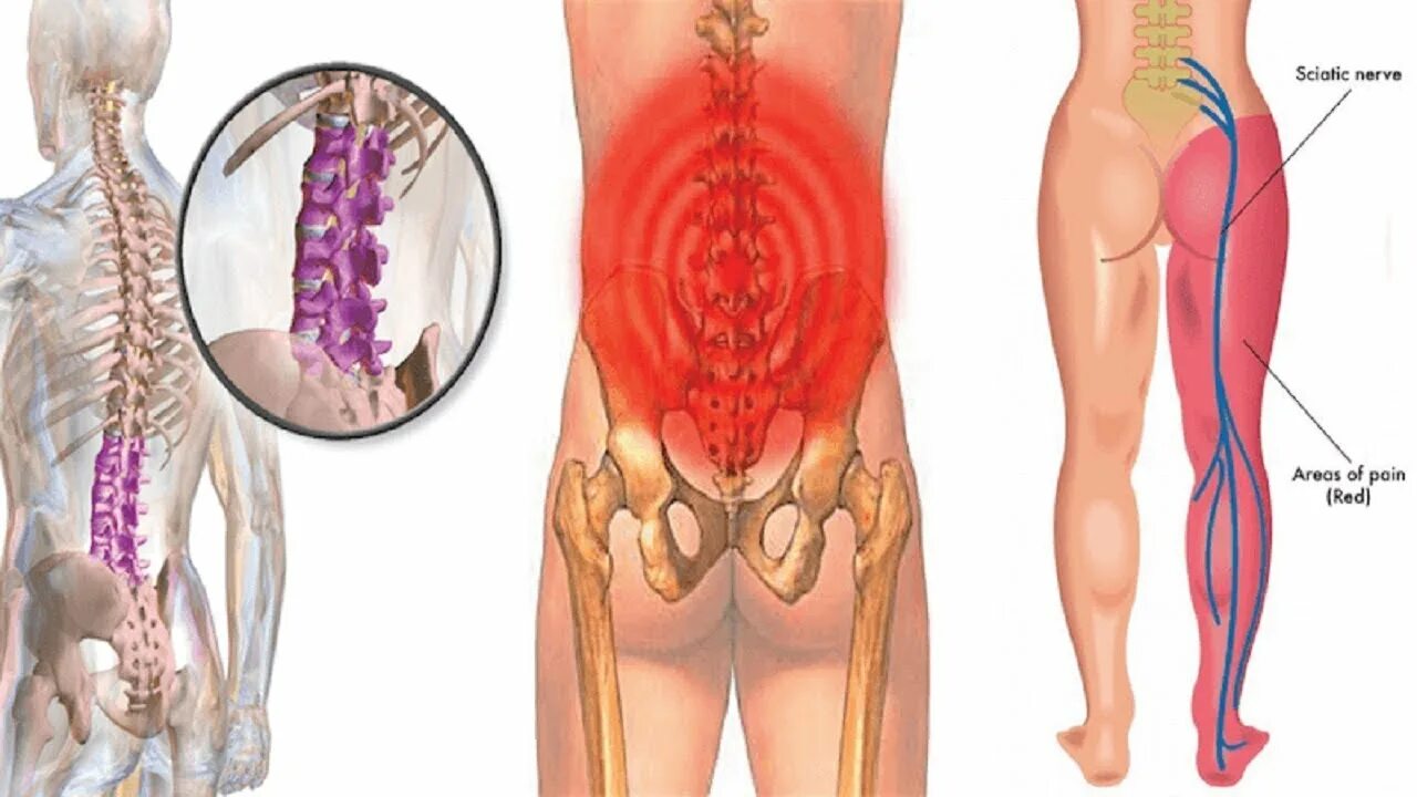 Болит поясница и левая нога. Седалищный нерв л5 с1. Седалищный нерв в пояснице. Защемление седалищного нерва анатомия. Ушиб поясницы седалищный нерв.