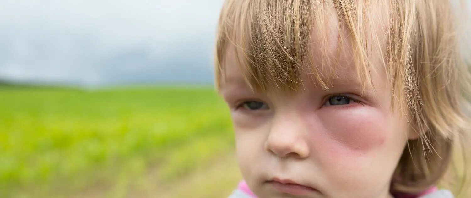 Аллергические глаза у детей. Удар крапивой