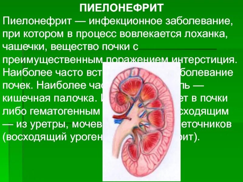 Заболевание почек конспект. Острый пиелонефрит симптомы. Нефрит ,пиелонефрит почек.