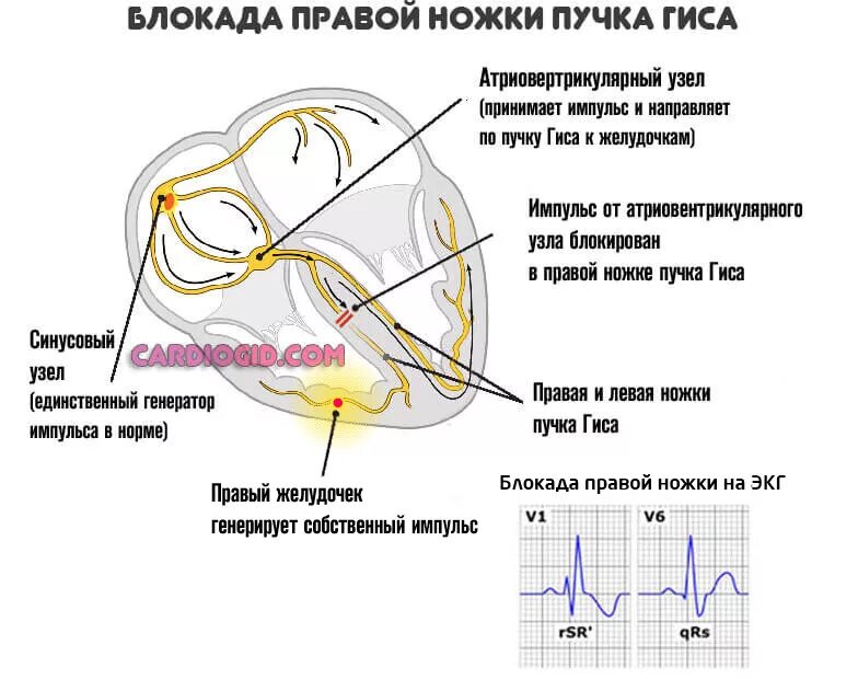 Блокада сердца это опасно. Блокада левых ножек пучка Гиса. Блокада левой и правой ножек пучка Гиса на ЭКГ. Блокада блокада ножек пучка Гиса на ЭКГ. Описание ЭКГ при блокаде правой ножки пучка Гиса.