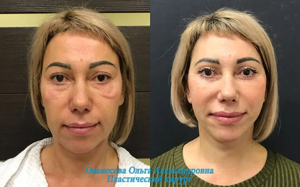 что такое чек лифтинг малярных мешков. малярные мешки после блефаропластики. блефаропластика малярные мешки. блефаропластика малярные мешки. неудачная блефаропластика.