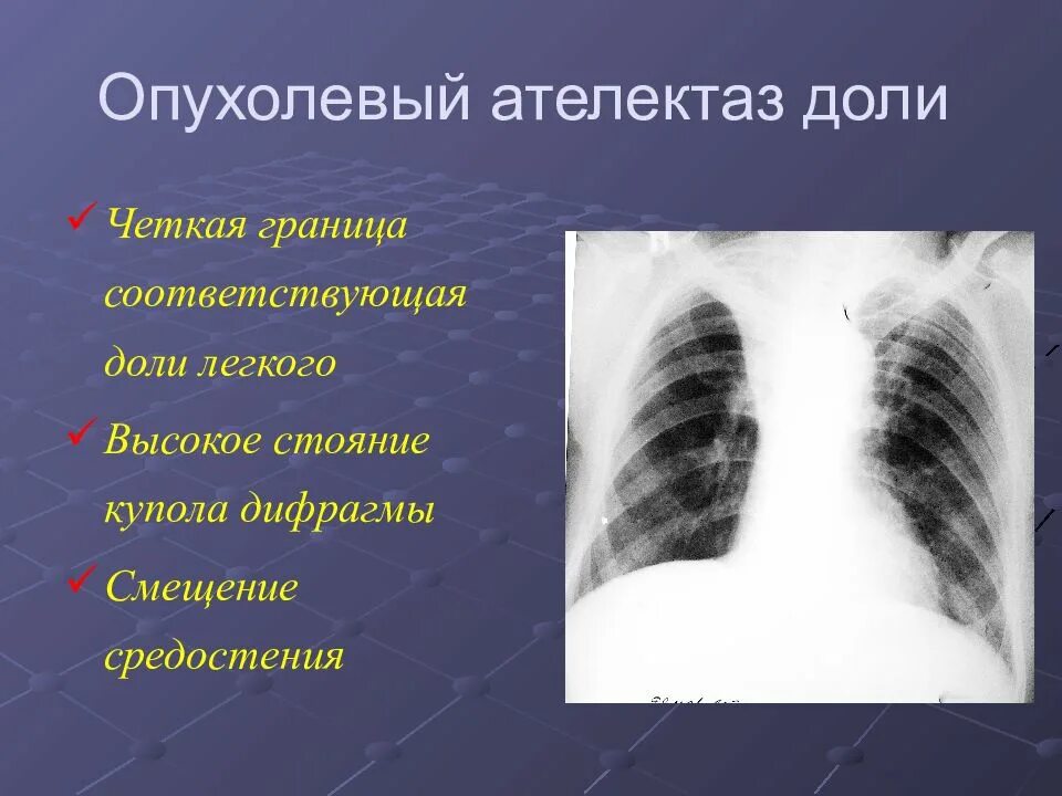 Ателектаз левой доли легкого. Компрессионный ателектаз легкого рентген. Компрессионный ателектаз рентген. Ателектаз смещение средостения. Ателектаз на рентгене.