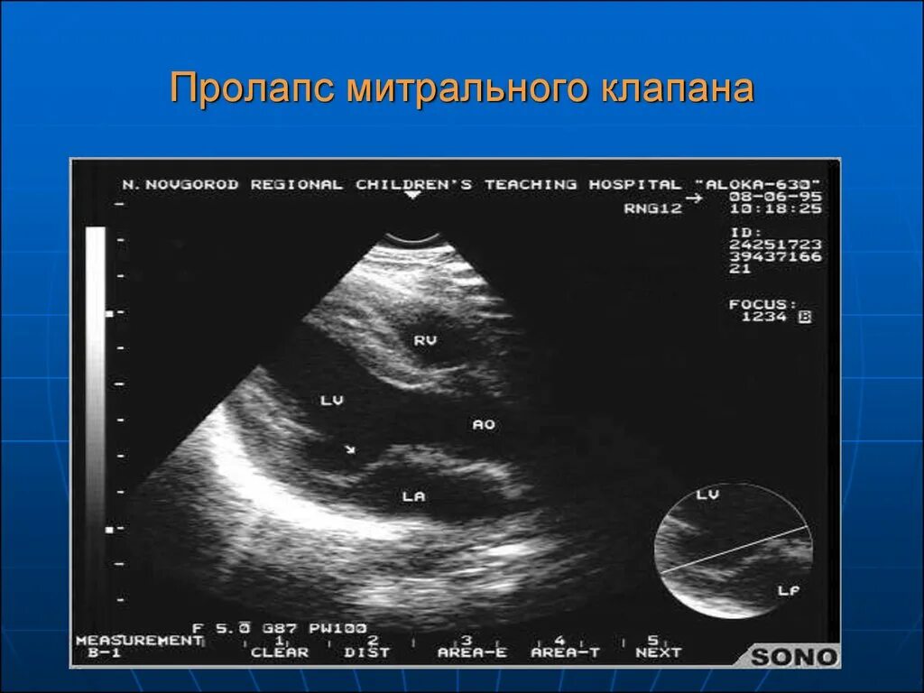 Что такое пролапс митрального клапана. ЭХОКГ пролапс митрального клапана 1 степени. Пролапс митр клапана. Элонгация передней створки митрального клапана. Прогиб створки митрального клапана.