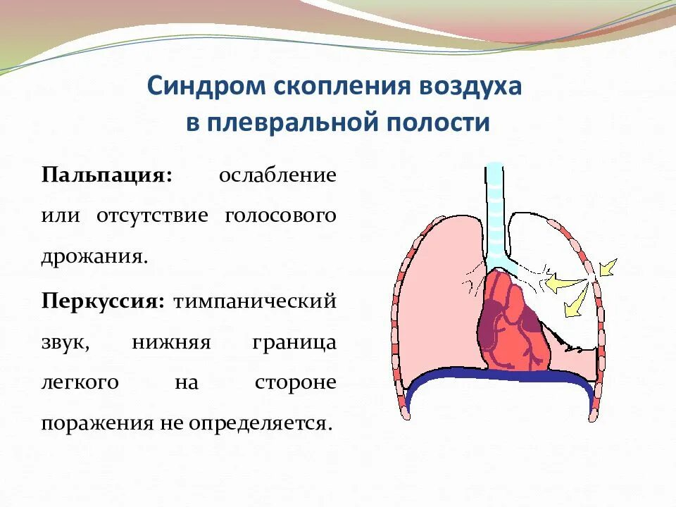 Признаки воздуха в легких. Скопление воздуха в плевральной полости. Синдром скопления воздуха в плевральной полости. Воздух в плевральной полости. Синдром скопления воздуха в полости плевры.