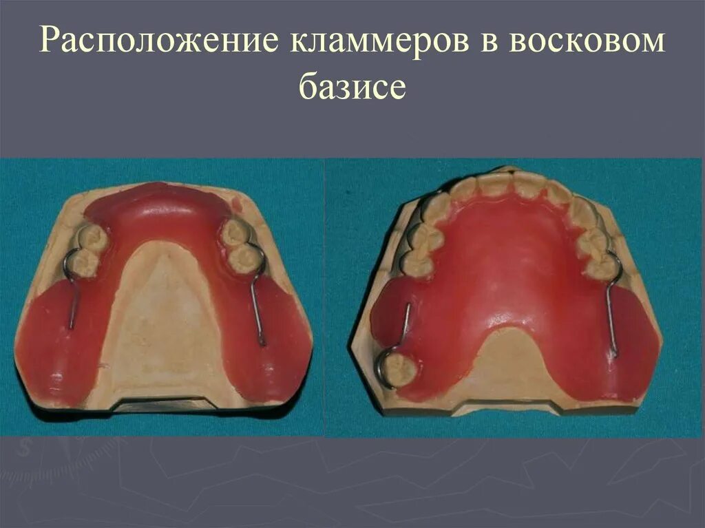 Границы пластиночного протеза. Расположение кламмеров на восковом базисе. Восковой Базис с окклюзионными валиками. Одноплечий кламмер в восковом базисе. Гнутый одноплечий кламмер.