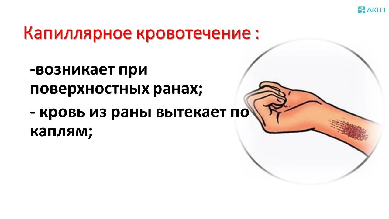 Симптомы капиллярного кровотечения капиллярное. Артериальное венозное и капиллярное кровотечение. Капиллярное кровотечение иллюстрация. Капилляр признаки капиллярного кровотечения.