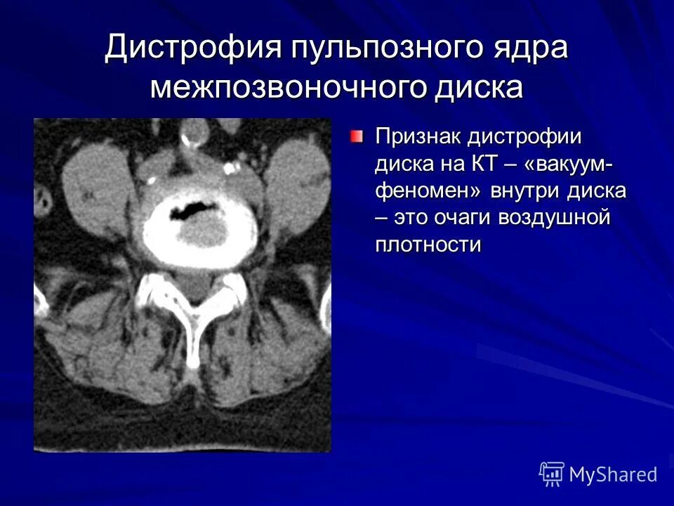 дегенерация межпозвоночного диска. жировая дегенерация межпозвонковых дисков. дегенеративное извинения позвоночника. остеопения l1 l2 позвонков. остеохондроз.