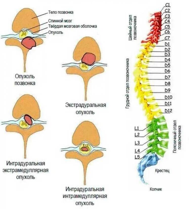 Боль в спинном мозге. Экстрамедуллярные опухоли поясничного отдела спинного мозга. Интрамедуллярного объемного образования спинного мозга. Опухоль позвоночника поясничного отдела симптомы. Опухоль на 5-6 позвонок спинного мозга.