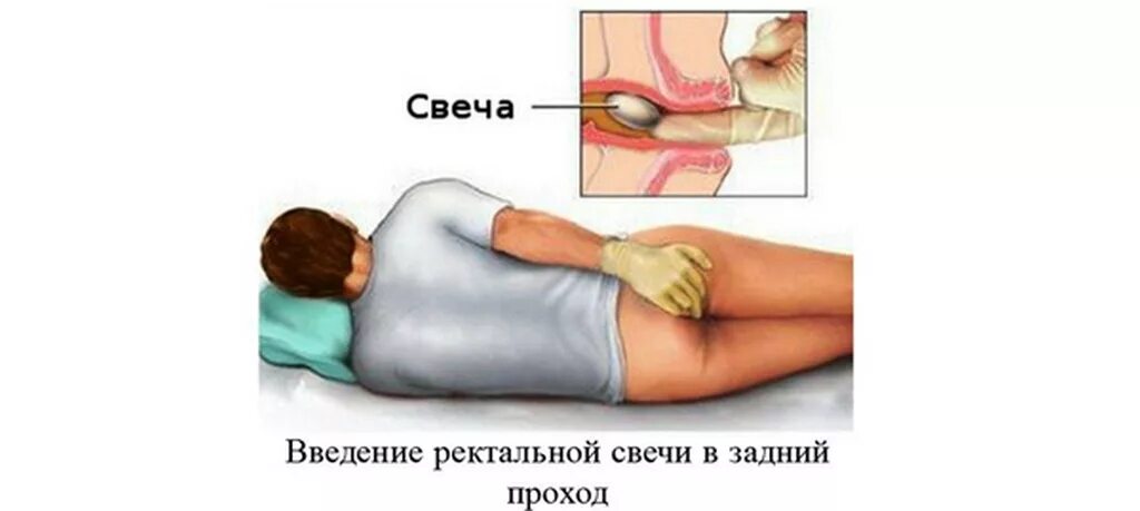 Введение ректального суппозитория. Введение свечи. Что такое ректальное Введение свечей. Ректально ведение свечи. Вставляет свечку видео