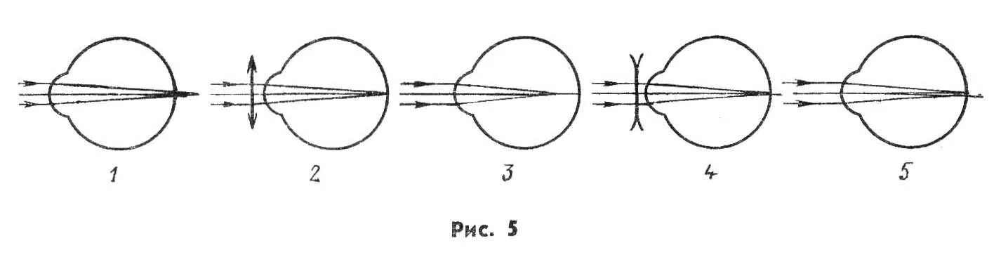 Ход лучей глаза человека. Схема хода параллельного пучка лучей дальнозоркого глаза. Ход лучей близорукость и дальнозоркость. Схемы хода лучей в глазе при близорукости и дальнозоркости. Близорукость ход лучей в глазе.