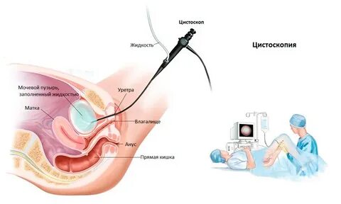 Удаление мочевого пузыря сколько длится операция