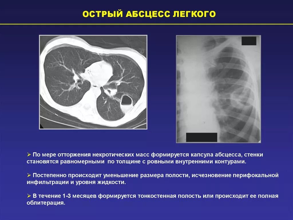 Без перифокальной реакции. Кт признаки абсцесса легких.