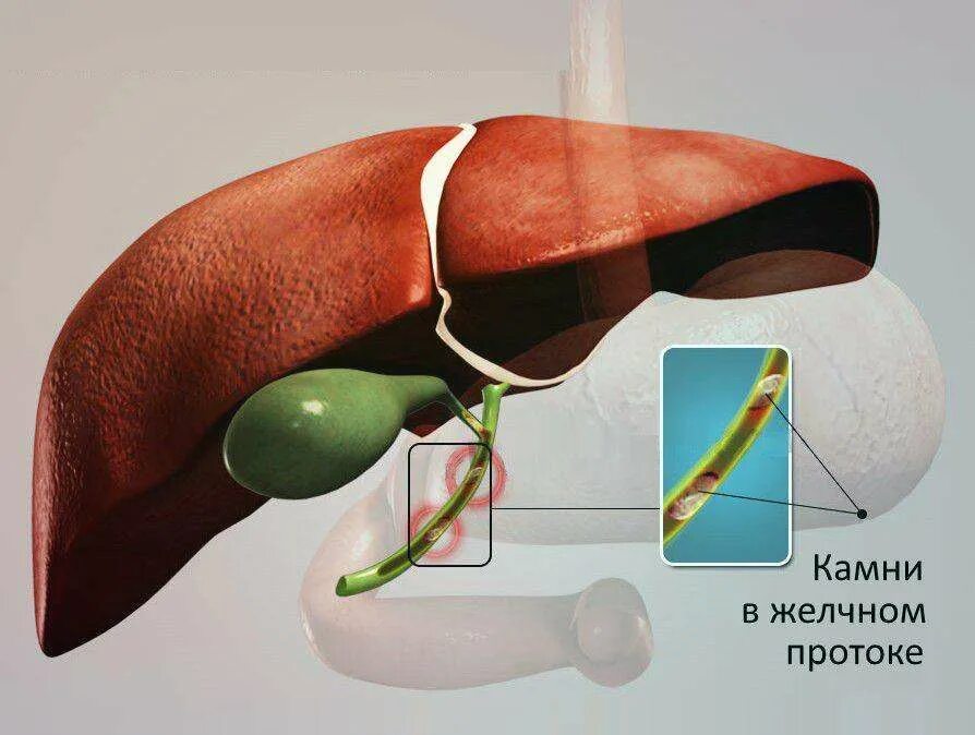 Камни в протоке печени. Желчекаменная болезнь холедохолитиаз. Холедохолитиаз механическая желтуха. Камень в протоке желчного пузыря. Желчекаменная болезнь холедохолитиаз механическая желтуха.