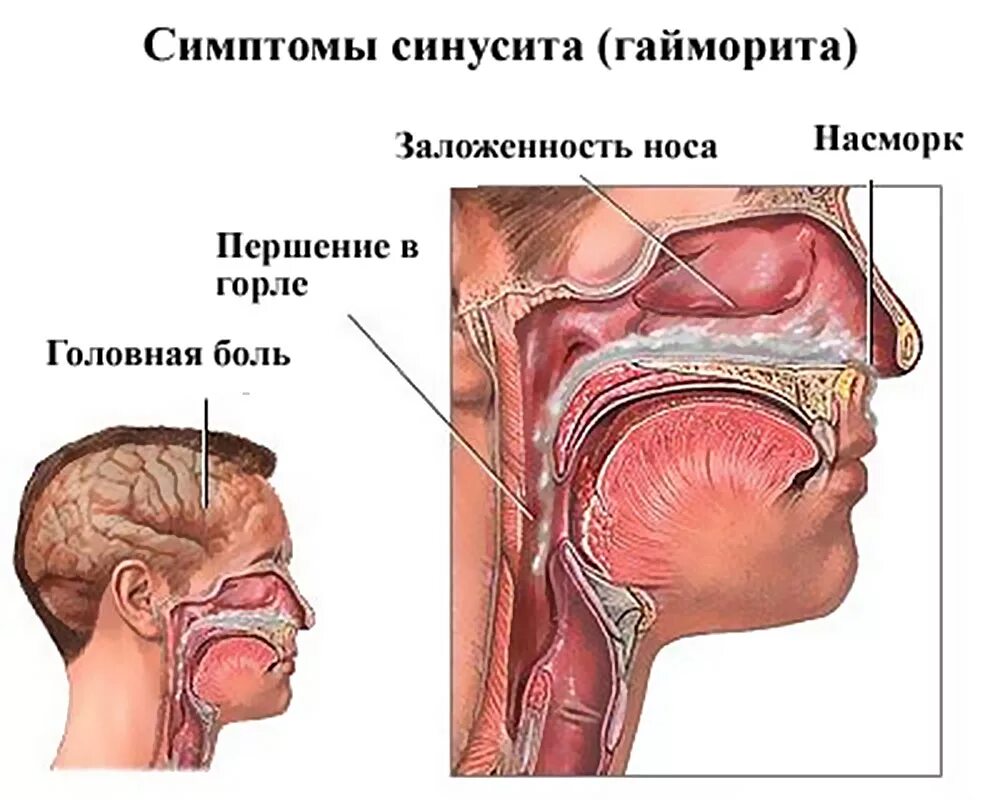 Гайморит симптомы чем лечить. Гайморит симптомы у взрослых. Гайморит причины возникновения.