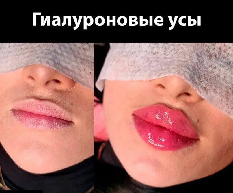 Усы после увеличения губ. Гиалуроновыц усы.