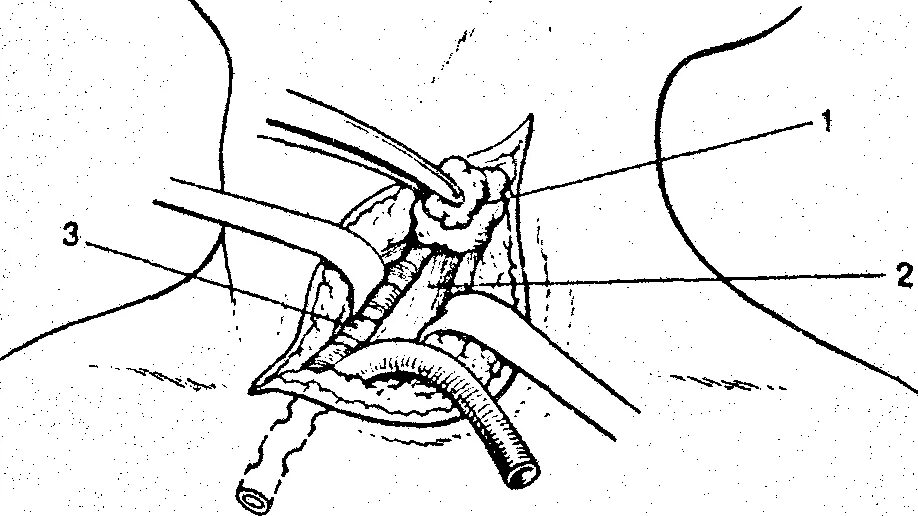 Шейная боковая медиастинотомия. Дренирование Разумовскому средостения. Дренирование заднего медиастинита.