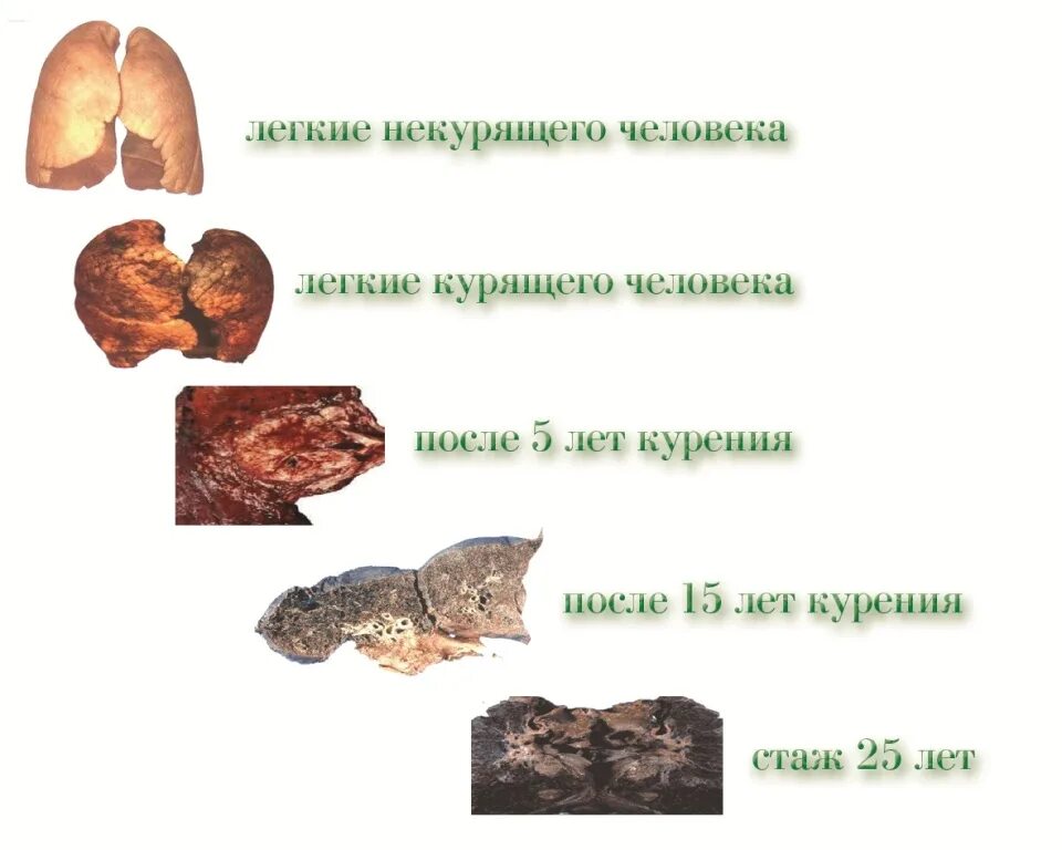 Организм после сигарет. Легкие парильщика 2 года. Как выглядят лёгкие курильщика. Лёгкие после года курения.