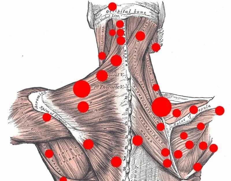 Лестничные мышцы триггерные точки. Миофасциальный синдром триггерные точки. Синдром лестничной мышцы триггерные точки. Миофасциальный синдром триггерные точки спины. Триггерные точки это простыми словами