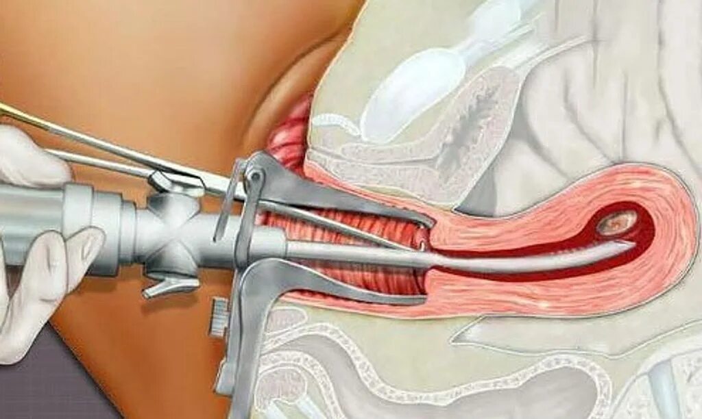 Выделения после вакуумной аспирации. Мини-аборт (вакуум-аспирация). Вакуумное выскабливание полости матки. Хирургическое выскабливание полости матки. Вакуум-экскохлеация полости матки.