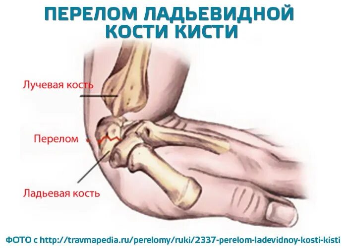 Упала сильно на руку. Лучевая кость запястья перелом. Перелом лучевой кости ноги пальцев. Перелом лучевой кости при падении на руку. Перелом лучезапястного сустава.