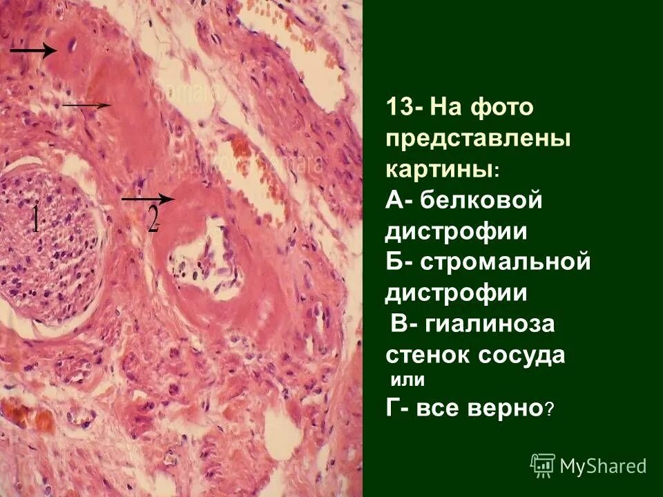 Дистрофия латынь. Сосудисто стромальная жировая дистрофия. Стромально-сосудистые дистрофии патологическая анатомия.