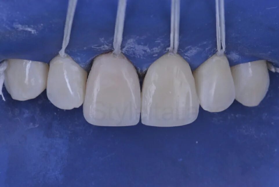 Материал для реставрации зубов. Реставрация зубов композитным материалом. Реставрация зуба композитным материалом. Художественная реставрация зубов композитным материалом. Восстановление переднего зуба композитным материалом.