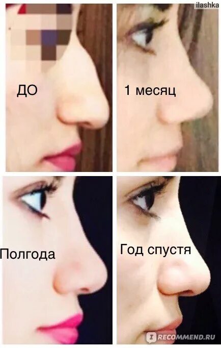 Конструкционная ринопластика от Григорянца В.С. Интернет-журнал Estetmedicina.ru