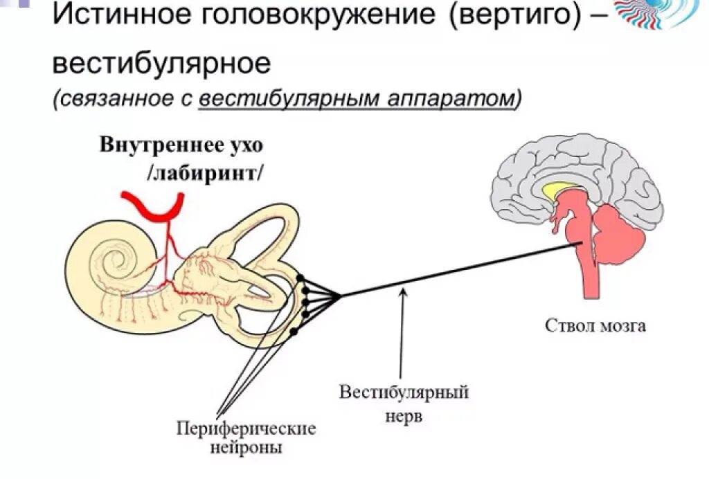 Истинное головокружение. Вестибулярные расстройства. Системное вестибулярное головокружение. Вертиго головокружение.