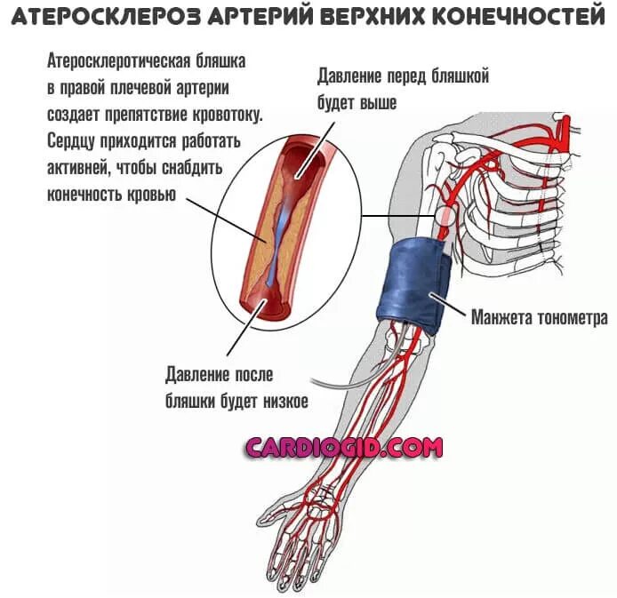 Низкое давление какие сосуды. Атеросклероз плечевой артерии. Атеросклероз сосудов верхних конечностей. Сосуды верхней конечности для измерения артериального давления.