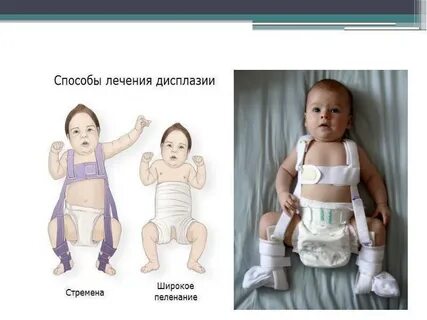 Дисплазия тазобедренных суставов у детей 3 месяца