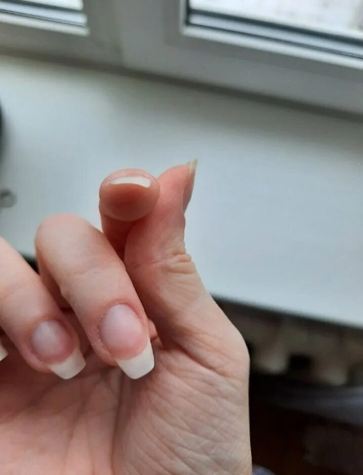 скручиваются ногти на руках. клюющие ногти. ногти загибаются по краям. загибается ноготь на указательном пальце. пожелтение ногтевой пластины.