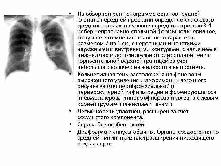 Корни малоструктурные что значит. На обзорной рентгенограмме уровни. Образование в проекции корня легкого. Обзорная рентгенограмма органов грудной клетки.